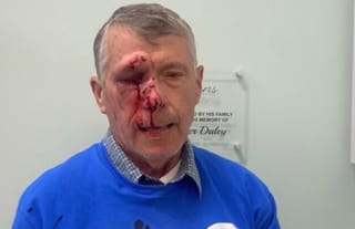 Mark Crosby suffered multiple facial fractures and temporary blindness. Photo: LifeNews.com
