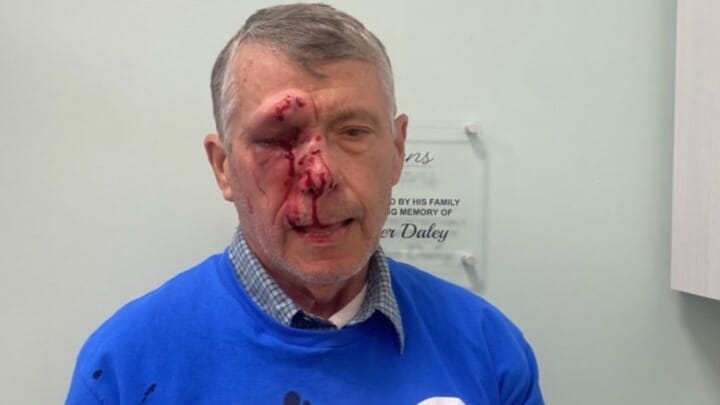 Mark Crosby suffered multiple facial fractures and temporary blindness. Photo: LifeNews.com